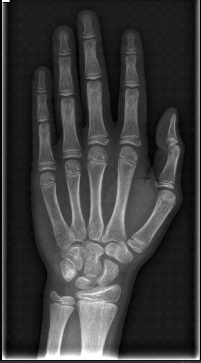 Röntgenfoto linkerhand